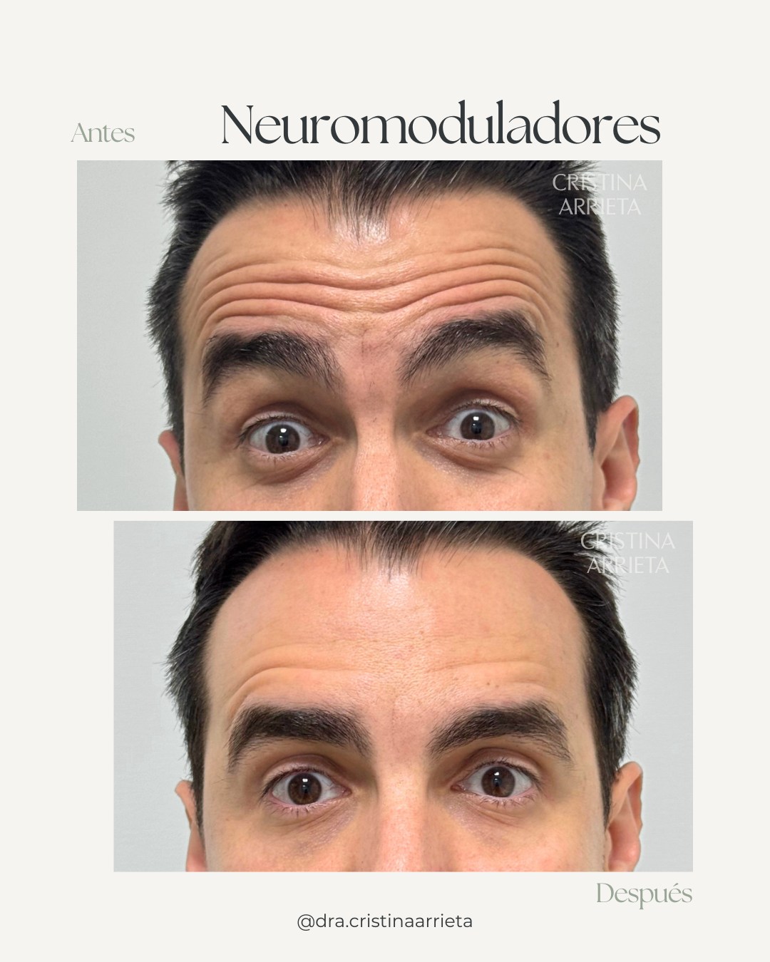 Frente, antes y después