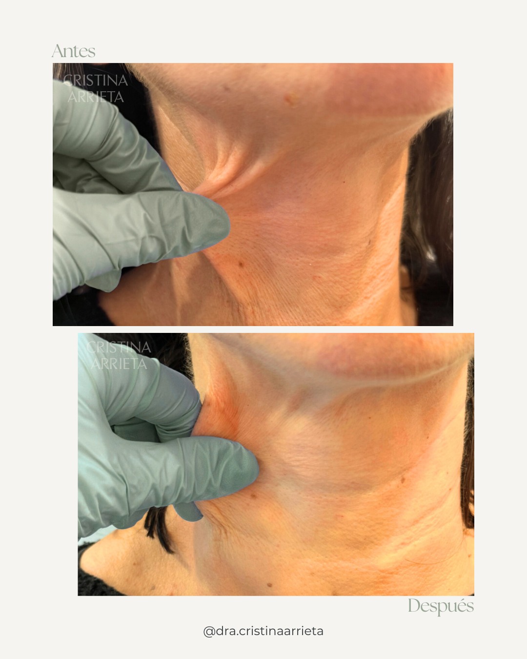 Cuello, antes y después