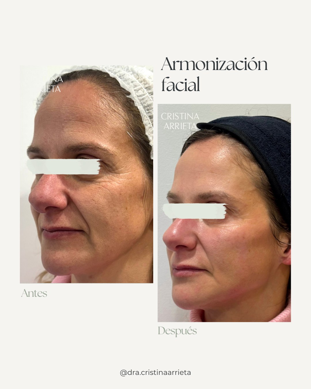Armonización facial, antes y después